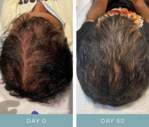 imgi_4_Hair-Loss-BA-Ali